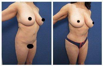 Best female abdominal contouring Best female abdominal contouring
