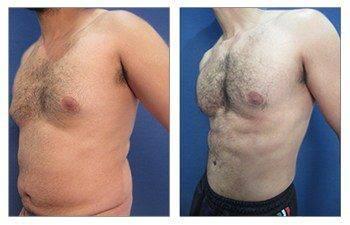 Gynecomastia Gynecomastia