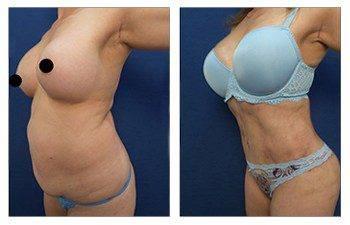 Tummy tuck and HD Liposuction before and after. Tummy tuck and HD Liposuction before and after.