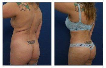 A woman's butt before and after a Mini Mommy Makeover, which includes a tummy tuck. A woman's butt before and after a Mini Mommy Makeover, which includes a tummy tuck.