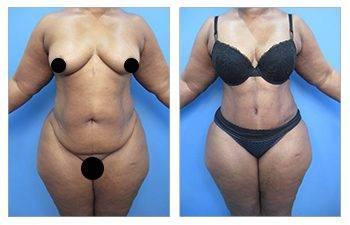 Best Liposuction Surgeon Best Liposuction Surgeon