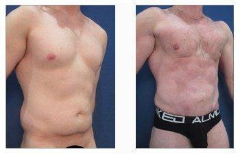 male square chest patient front right view male square chest patient front right view
