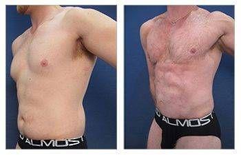 Tummy tuck before and after Tummy tuck before and after