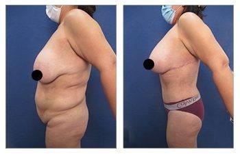 Brazilian Butt Lift Revision Specialist — patient photo Brazilian Butt Lift Revision Specialist — patient photo