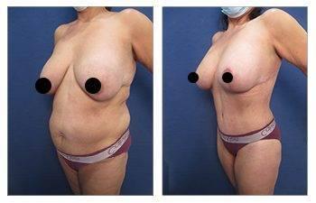 BMI in Body Contouring BMI in Body Contouring