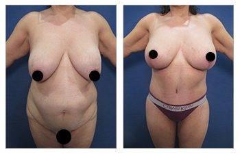 Medial thigh tuck for plus sized clients Medial thigh tuck for plus sized clients