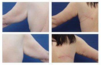 orange county brachioplasty newport beach patient 8 arms orange county brachioplasty newport beach patient 8 arms