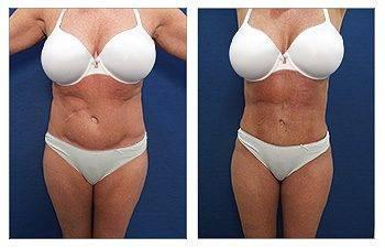 Liposuction Side Effects Liposuction Side Effects