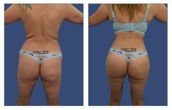 A woman's buttocks before and after liposuction, with the benefits of a free BBL procedure. A woman's buttocks before and after liposuction, with the benefits of a free BBL procedure.