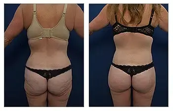 A woman's buttock before and after liposuction for Buttock Augmentation Surgery. A woman's buttock before and after liposuction for Buttock Augmentation Surgery.