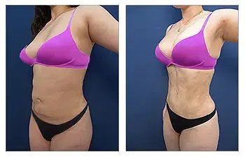 High Definition Mini Tummy Tuck before and after. High Definition Mini Tummy Tuck before and after.