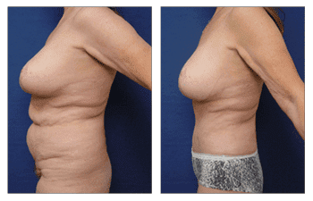 Will Insurance Cover a Body Lift Will Insurance Cover a Body Lift
