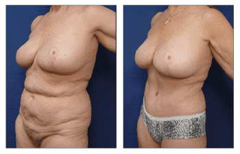 Body Contouring Post Bariatric Surgery Body Contouring Post Bariatric Surgery