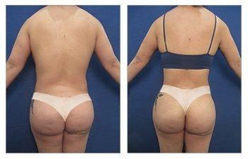 Tummy tuck and BBL surgery before and after. Tummy tuck and BBL surgery before and after.