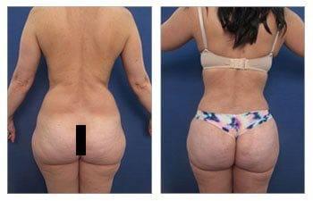 Before and after pictures showcasing a woman's remarkable buttlift transformation. Before and after pictures showcasing a woman's remarkable buttlift transformation.