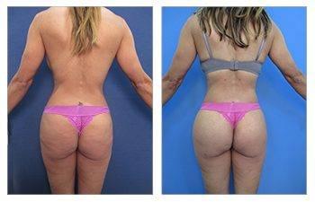 Increase in Brazilian Buttock Lifts in California Increase in Brazilian Buttock Lifts in California