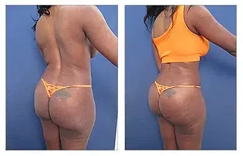 A woman's posterior before and after liposuction, a potential butt implant alternative. A woman's posterior before and after liposuction, a potential butt implant alternative.
