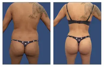 Tummy tuck and buttocks enhancement before and after photo. Tummy tuck and buttocks enhancement before and after photo.