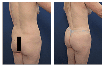 A woman's breasts before and after breast surgery as part of a Mommy Makeover to create improved proportions. A woman's breasts before and after breast surgery as part of a Mommy Makeover to create improved proportions.
