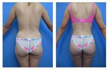Brazilian Butt Lift Fat Emboli Brazilian Butt Lift Fat Emboli