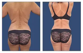 Back-Contouring-5.0-BGOK (1) Back-Contouring-5.0-BGOK (1)