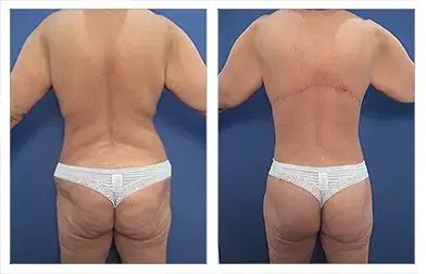SurgiSculpt SurgiSculpt