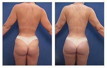 How to Correct Butt Cellulite How to Correct Butt Cellulite