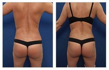 Brazilian Buttock Lift Newport Beach Brazilian Buttock Lift Newport Beach