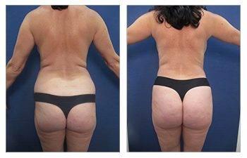 Why is VASER liposuction ideal for BBL Why is VASER liposuction ideal for BBL