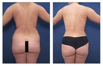 Before and after pictures of a woman's tummy tuck in preparation for a BBL revision. Before and after pictures of a woman's tummy tuck in preparation for a BBL revision.