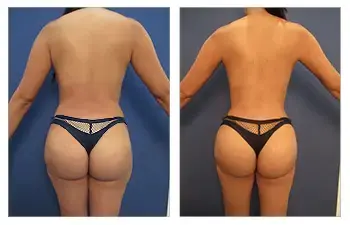 Why BBL Revision Cannot be Performed After Laser Liposuction Why BBL Revision Cannot be Performed After Laser Liposuction