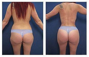 Will I Lose 40% Of My Butt Volume Following BBL? Will I Lose 40% Of My Butt Volume Following BBL?