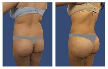 How Common is Buttock Implants How Common is Buttock Implants