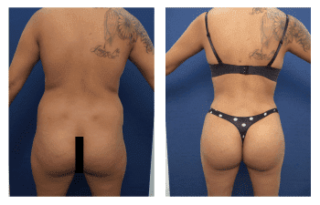 26 year old who underwent bilateral buttocks augmentation with silicone implants as well as liposuction of her flanks and lateral thighs. 26 year old who underwent bilateral buttocks augmentation with silicone implants as well as liposuction of her flanks and lateral thighs.