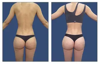 SurgiSculpt® BBL SurgiSculpt® BBL