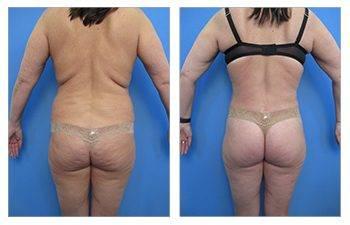 Tummy tuck to fix a sagging butt, with visible before and after results. Tummy tuck to fix a sagging butt, with visible before and after results.