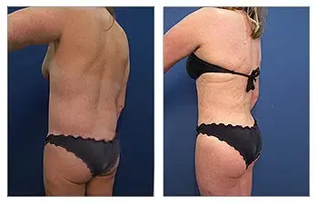 A woman in a bikini showcasing her drastic transformation after liposuction, with noticeable changes in body contour and enhanced buttocks. A woman in a bikini showcasing her drastic transformation after liposuction, with noticeable changes in body contour and enhanced buttocks.