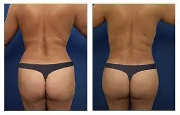 Brazilian Butt Lift Revision Recovery Brazilian Butt Lift Revision Recovery