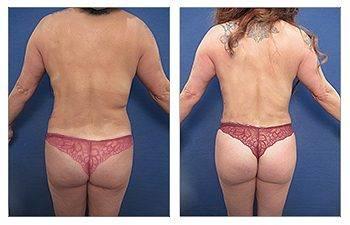 A woman's butt before and after a Mini Mommy Makeover, which includes a tummy tuck. A woman's butt before and after a Mini Mommy Makeover, which includes a tummy tuck.