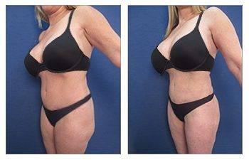 Why is VASER liposuction ideal for Brazilian Buttock Lift Why is VASER liposuction ideal for Brazilian Buttock Lift