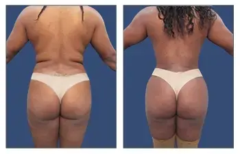 Back-Contouring-3-BGOK (1) Back-Contouring-3-BGOK (1)