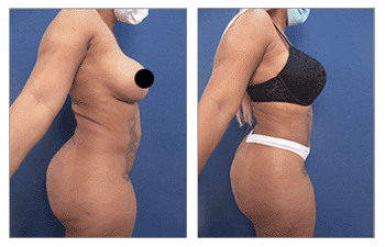 Tummy tuck before and after transformation achieved by skilled BBL Revision Doctors. Tummy tuck before and after transformation achieved by skilled BBL Revision Doctors.