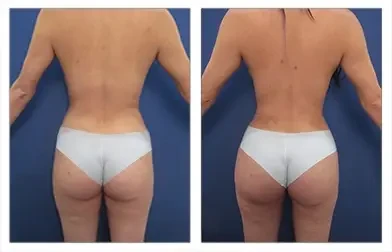 Liposuction — #SS118 Liposuction — #SS118