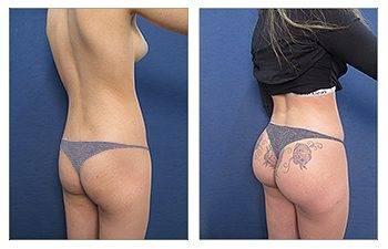 Butt Implant Cost Butt Implant Cost