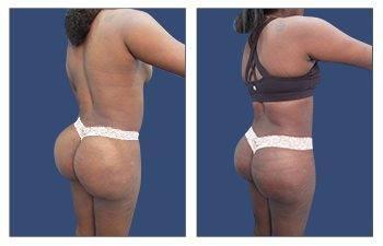 Butt LProper Buttock Implant Placementift 5 BGOK Butt LProper Buttock Implant Placementift 5 BGOK
