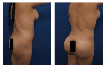 Buttock Implant Risks Buttock Implant Risks