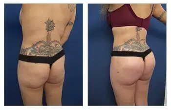 Before and after pictures of a woman with tattoos on her buttocks undergoing a transformation with round or oval buttock implants. Before and after pictures of a woman with tattoos on her buttocks undergoing a transformation with round or oval buttock implants.