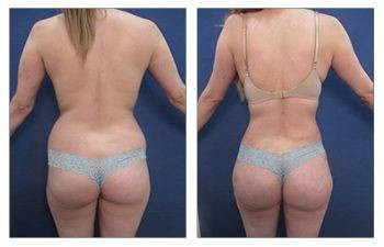 Fat Grafting — #SS368 Fat Grafting — #SS368