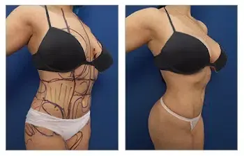 Tummy tuck before and after. Tummy tuck before and after.
