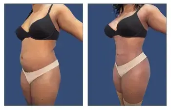 Tummy tuck before and after. Tummy tuck before and after.